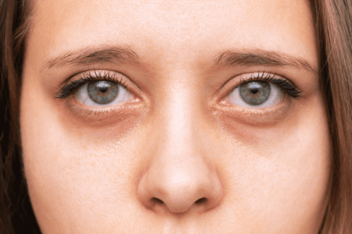 Does Aloe Vera Reduce Dark Circles, Dark Circles