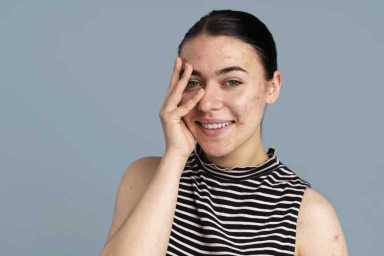 Moisturizer for Acne-Prone Skin